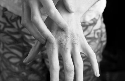 Skin eruptions