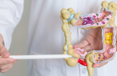 Intestinal irregularity