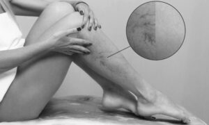 vene-dilatate