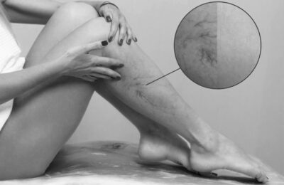 Dilated veins: thrombi, varicosis, haemorrhoids